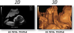 2D and 3D fetal profile