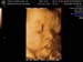 3D 4D Ultrasound Sonoma Image