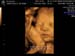 3D 4D Ultrasound Sonoma Image