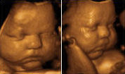 3D 4D
                                ultrasound image of babies